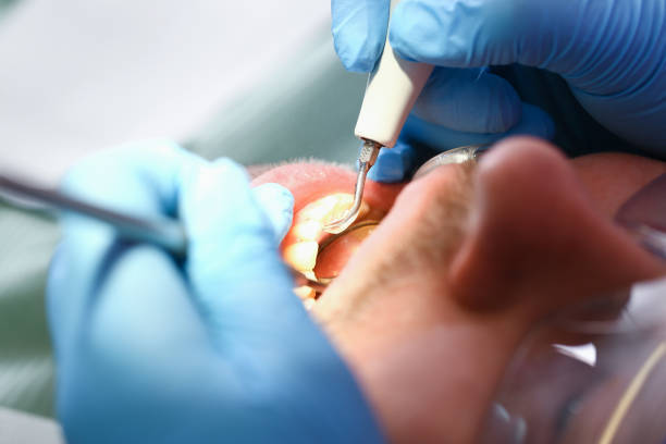 Best Emergency Broken Tooth Repair in Laurium, MI
