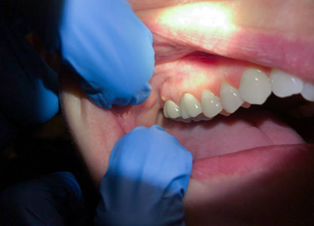 Best Emergency Wisdom Teeth Removal in Laurium, MI