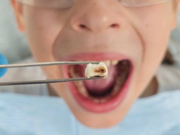 Best Emergency Broken Tooth Repair in Laurium, MI